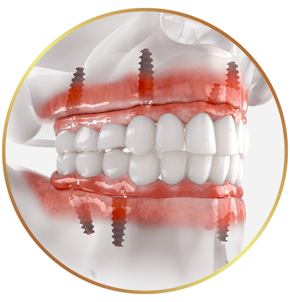 full mouth dental implant graphic