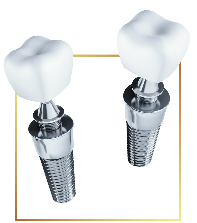 dental implants