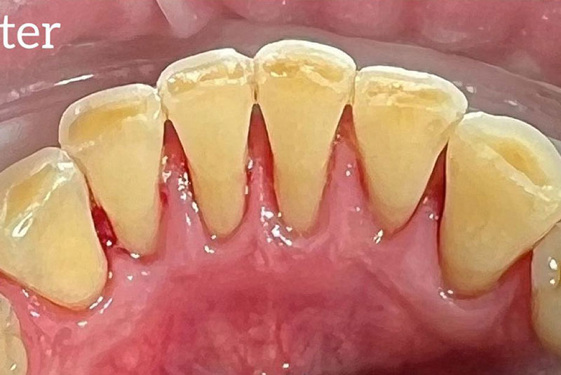 ba after cleaning case 22