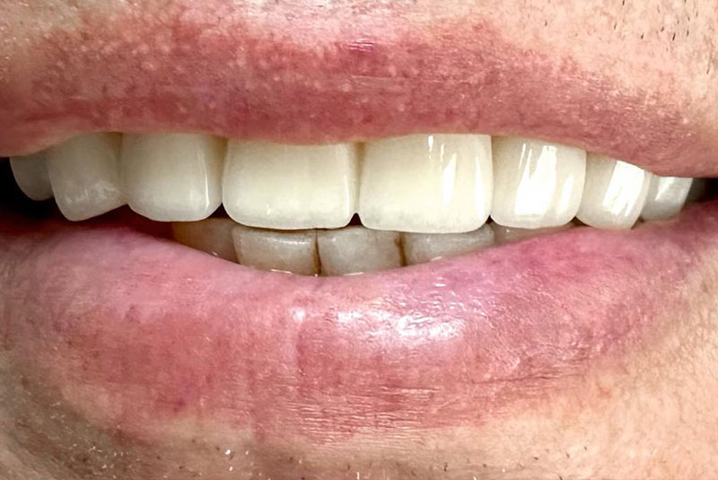 ba after crown case 15