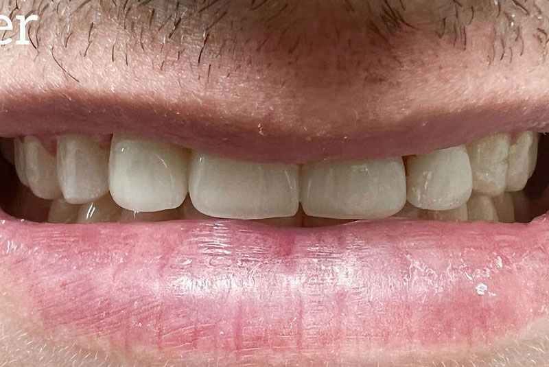 ba after crowns case 11