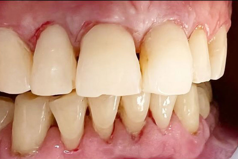 ba after fillings case 2