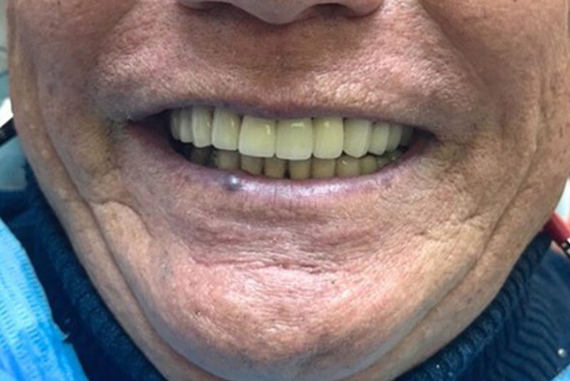 ba after implants case 16
