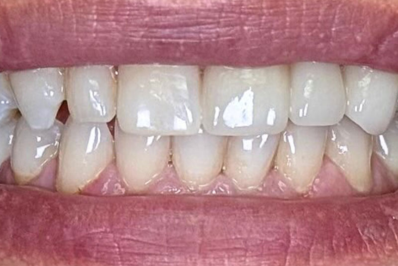 ba after porcelain bridge case 7