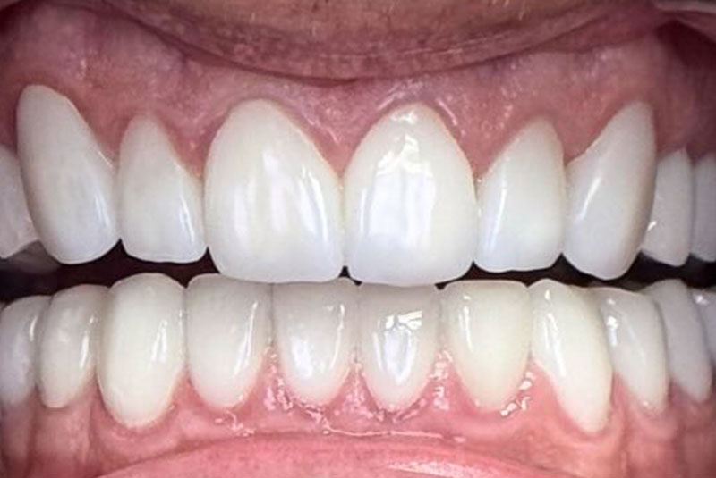 bae after porcelain crowns case 3