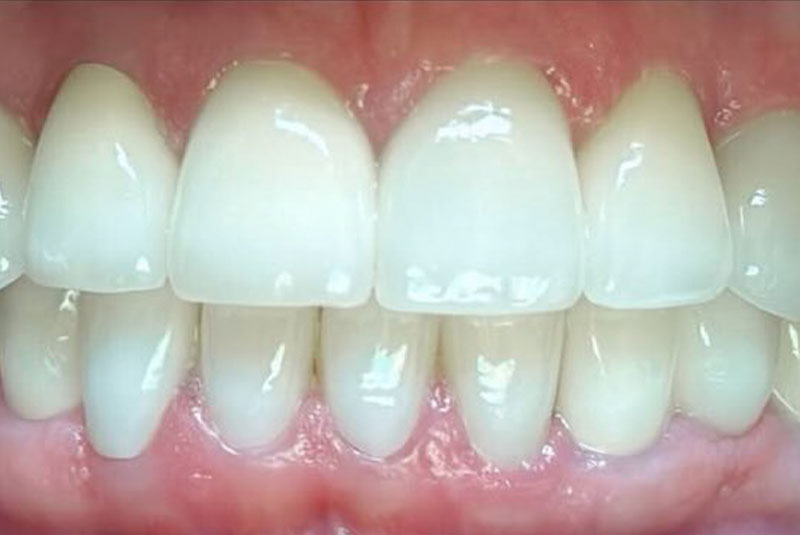 ba after porcelain crowns case 4