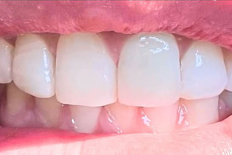 ba after porcelain crowns case5