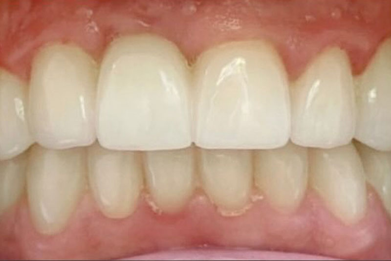 ba after porcelain crowns case 6
