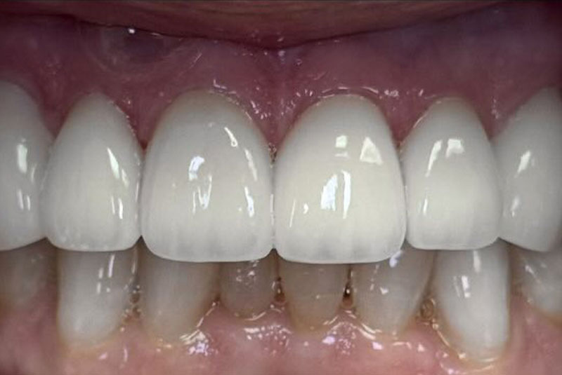 ba after upper arch case 1