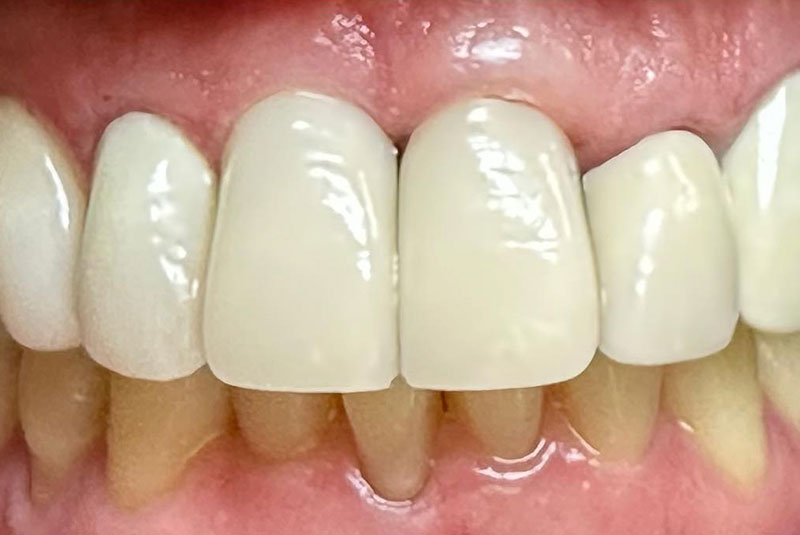 ba after veneers case 20