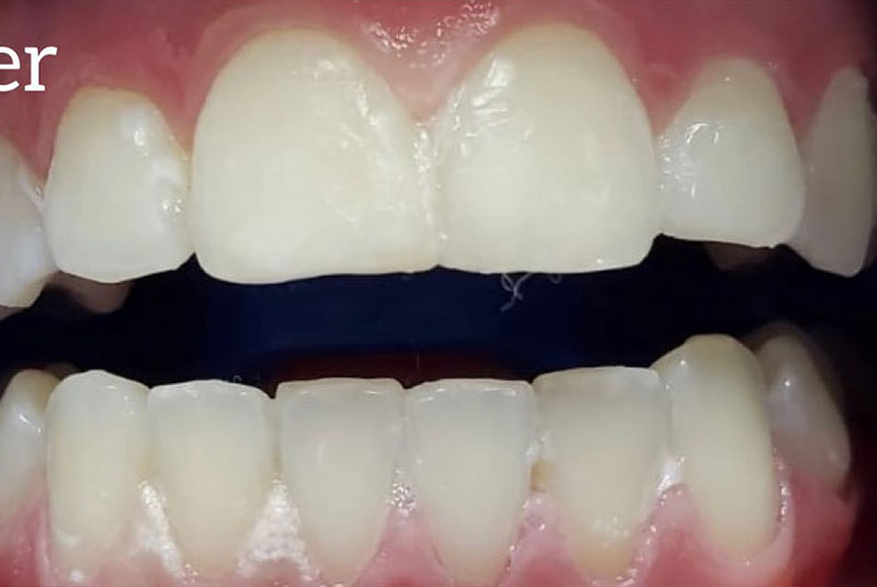 ba after whitening case 10