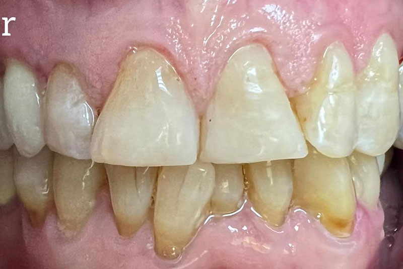 ba after whitening case 11