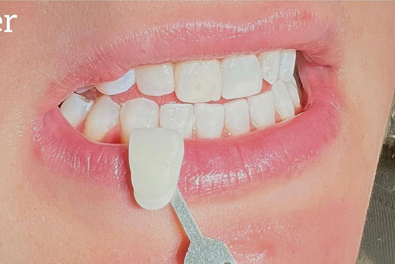ba after whitening case 12