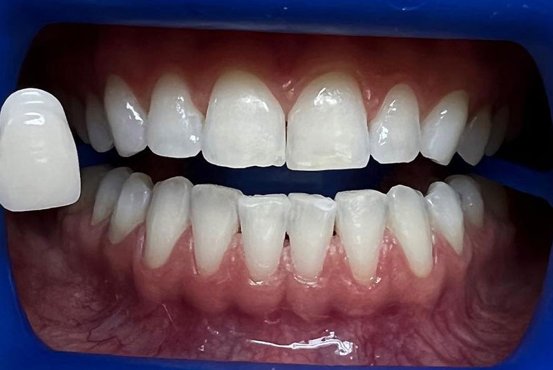 ba after whitening case 14