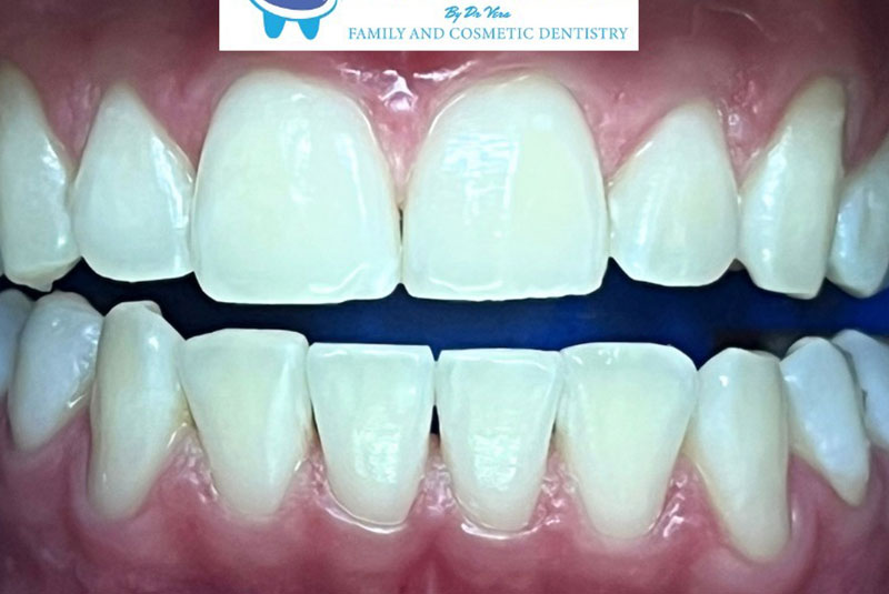 ba after whitening case 19