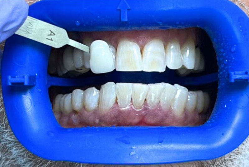ba after whitening veneer case 9