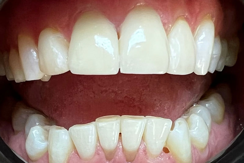ba after white veneers case 21