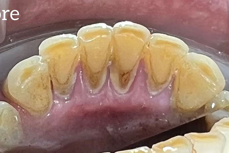 ba before cleaning case 22