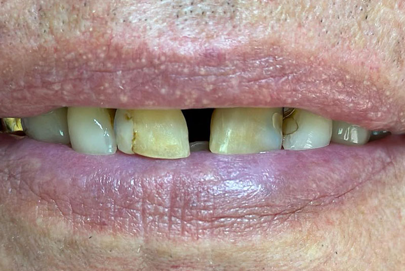 ba before crown case 15