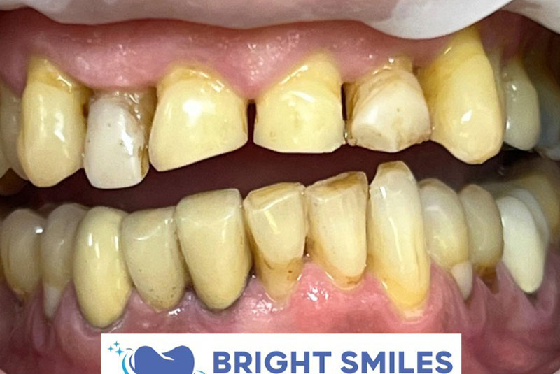 ba before dental crowns case 8