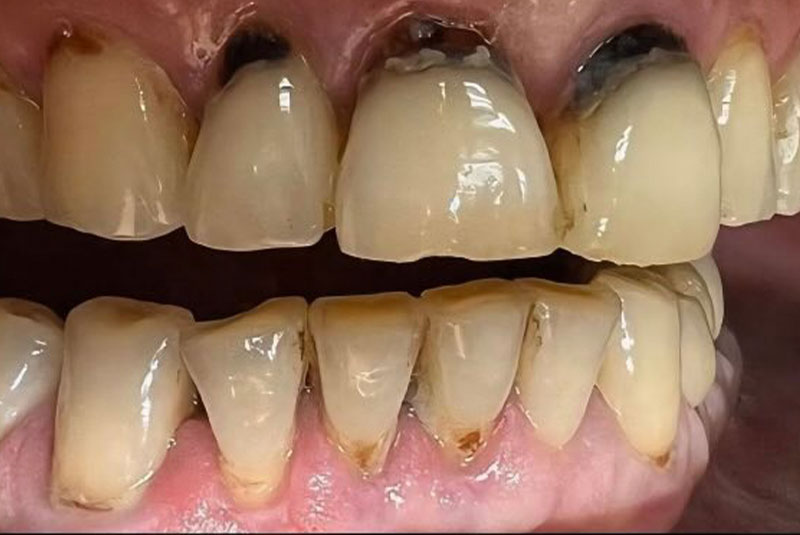 ba before fillings case 2