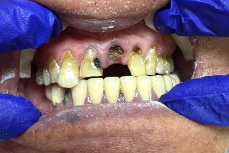 ba before implants case 16