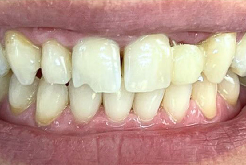 ba before porcelain bridge case 7