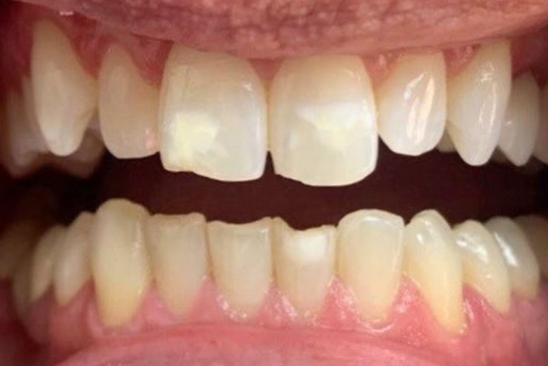 bae before porcelain crowns case 3