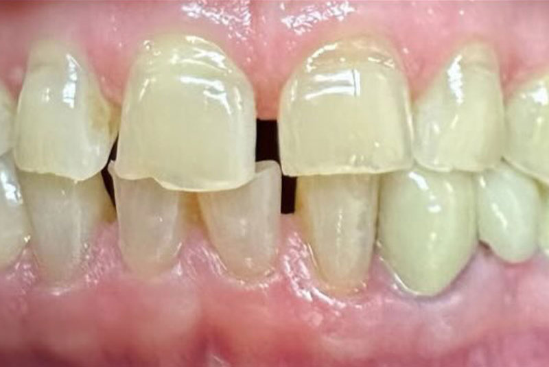 ba before porcelain crowns case 4