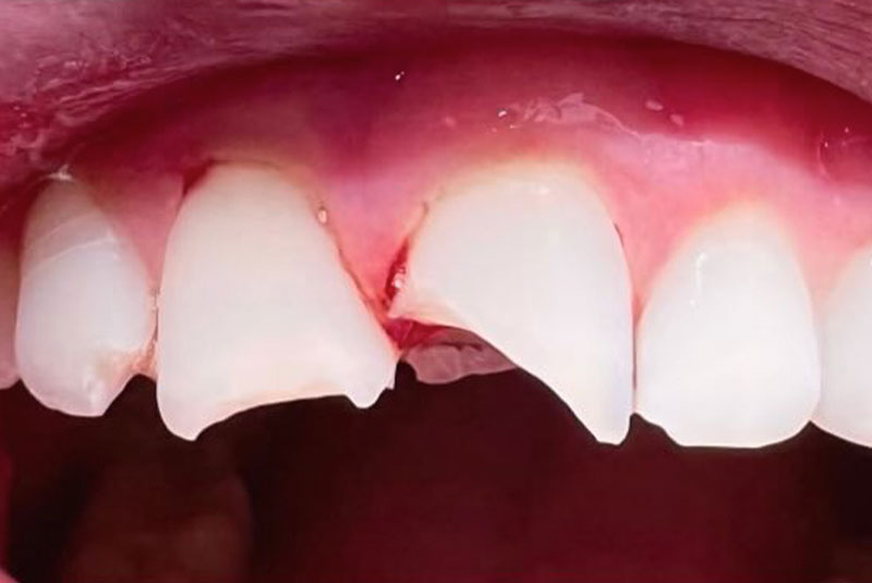 ba before porcelain crowns case5