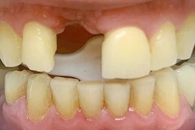 ba before porcelain crowns case 6