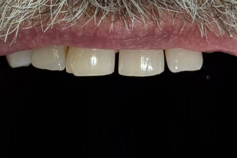 ba before upper arch case 1