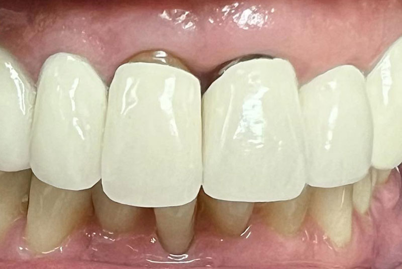 ba before veneers case 20