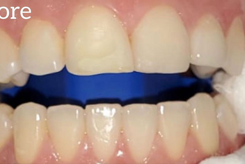 ba before whitening case 10
