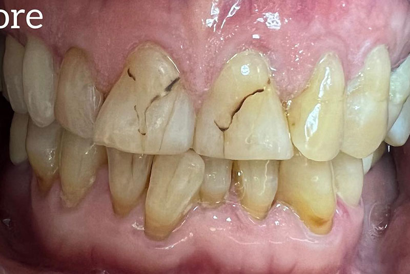 ba before whitening case 11