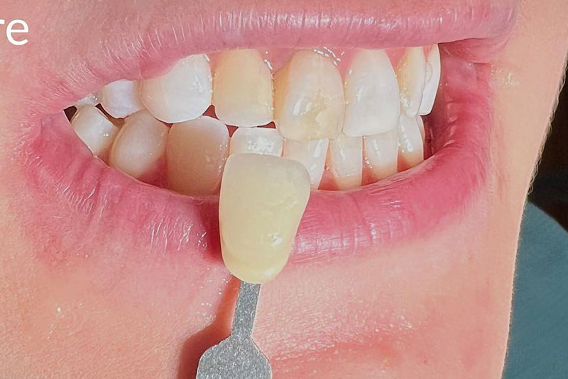 ba before whitening case 12