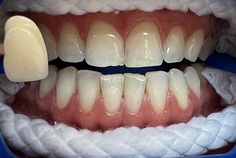 ba before whitening case 14