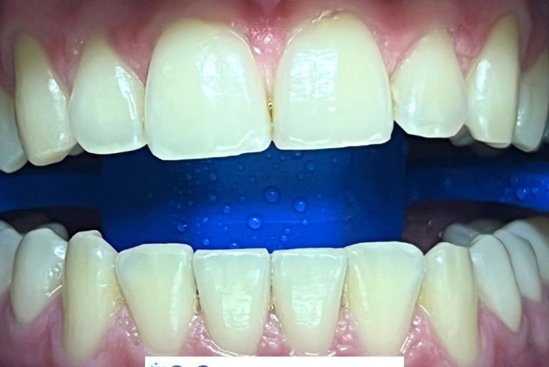 ba before whitening case 19