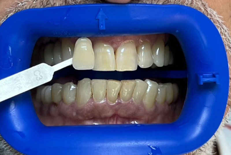 ba before whitening veneer case 9