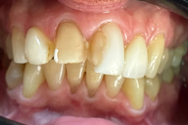 ba before white veneers case 21