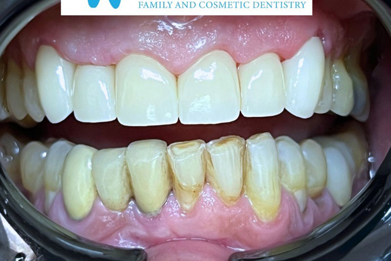 ba after dental crowns case 8