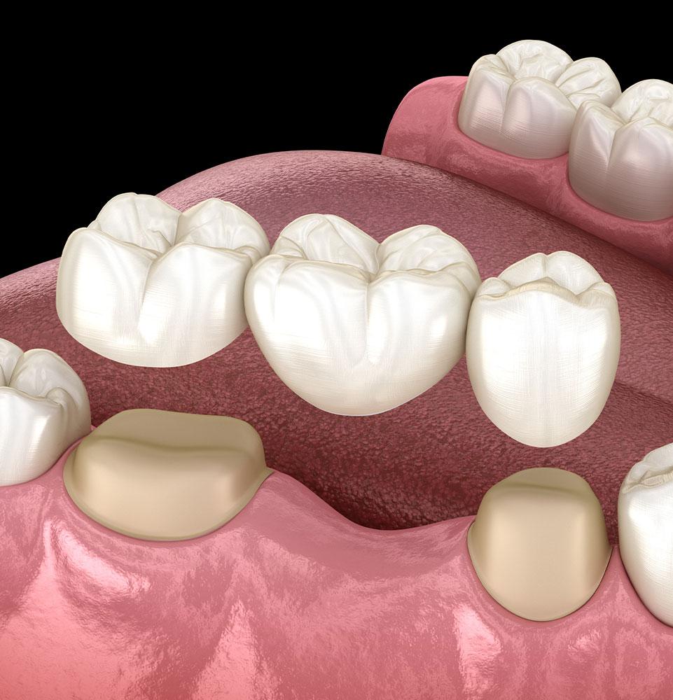 dental bridge 3d