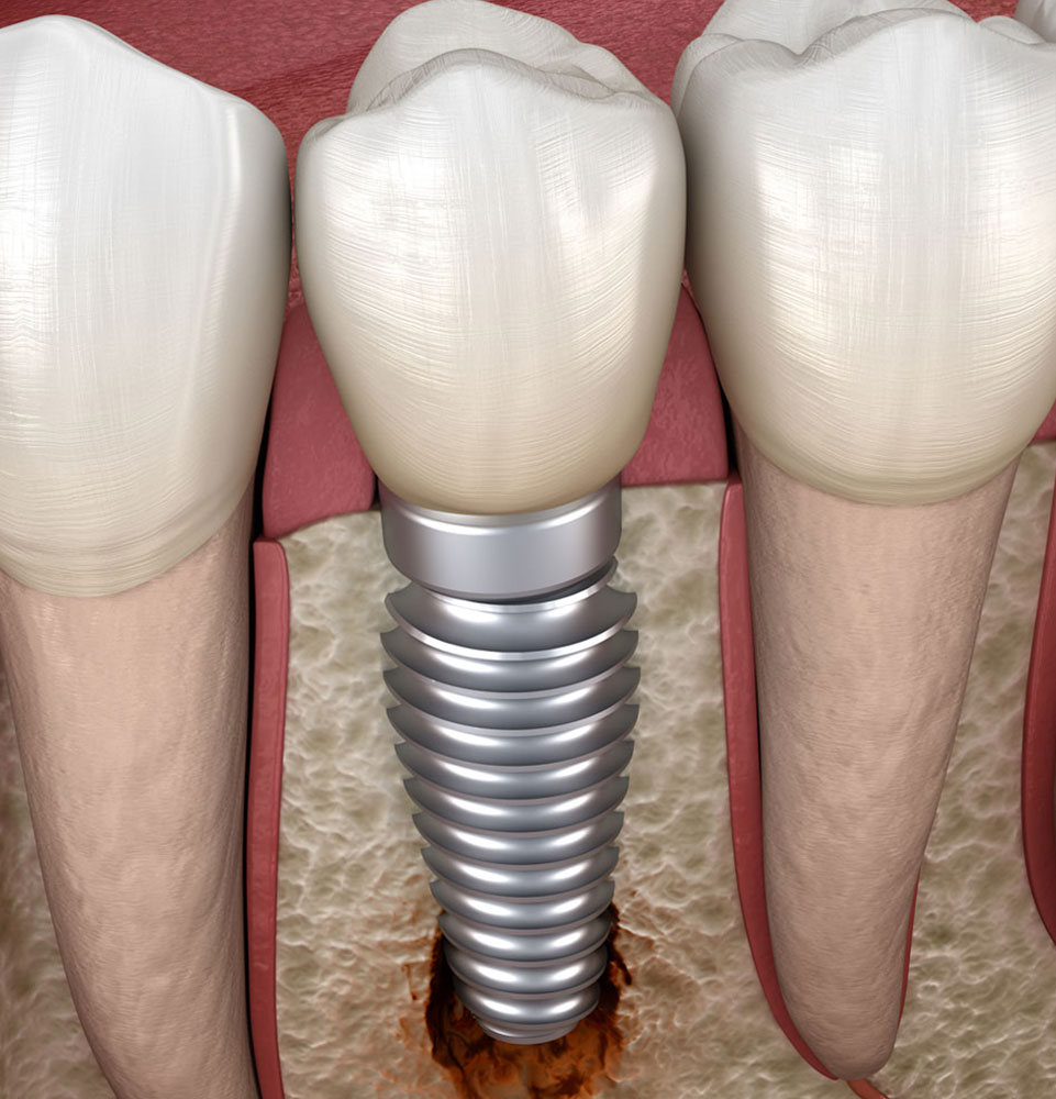 failing dental implant