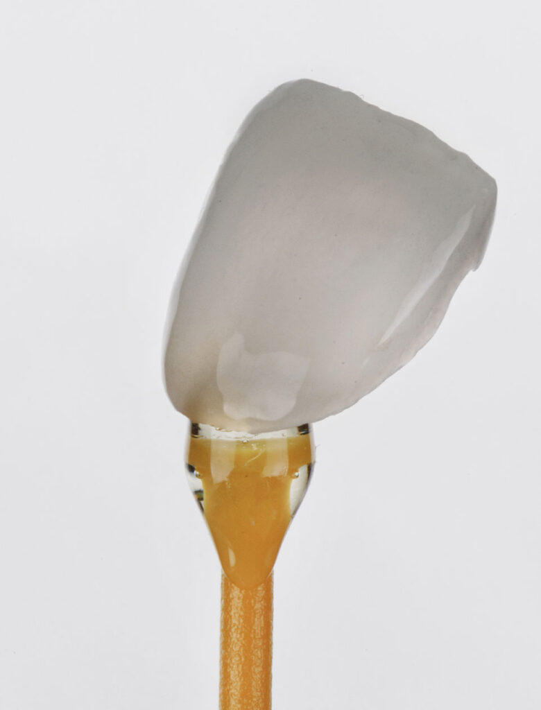 porcelain veneer