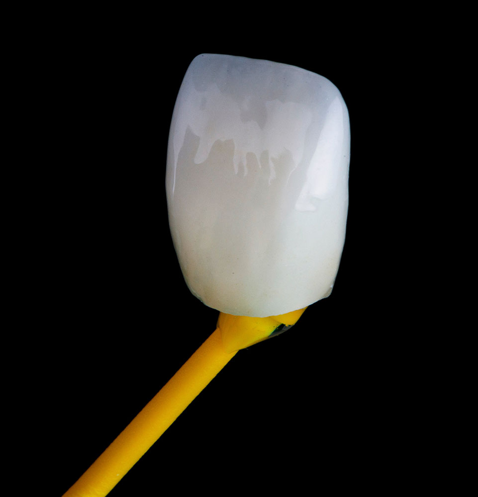 veneer lumineer up close
