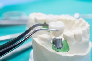 Dental Crowns Hallandale Beach, FL