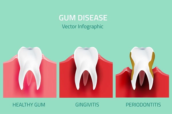 Gum Disease Hallandale Beach, FL