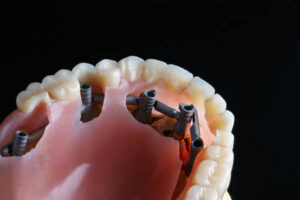 Implant Supported Dentures Hallandale Beach, FL
