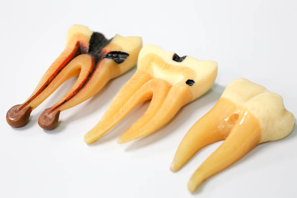 Root Canal Hallandale Beach, FL