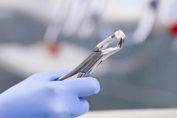 Tooth Extractions Hallandale Beach, FL